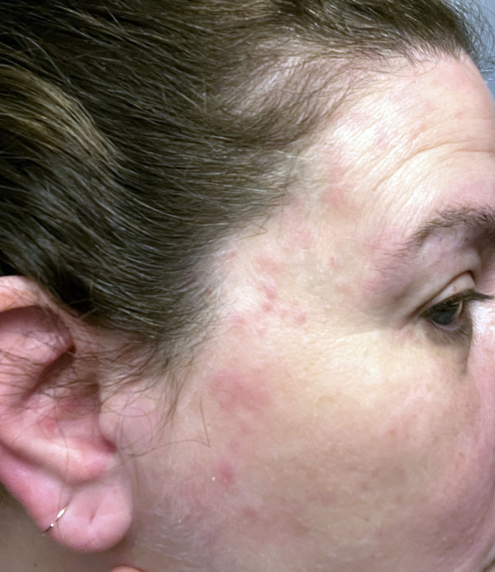 a closeup of the side of kim's face, she has a blotchy red rash